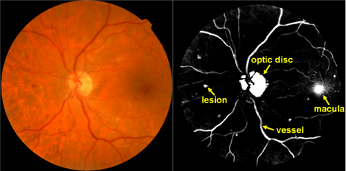 左图是眼底视网膜图像;右图是显著性分析结果